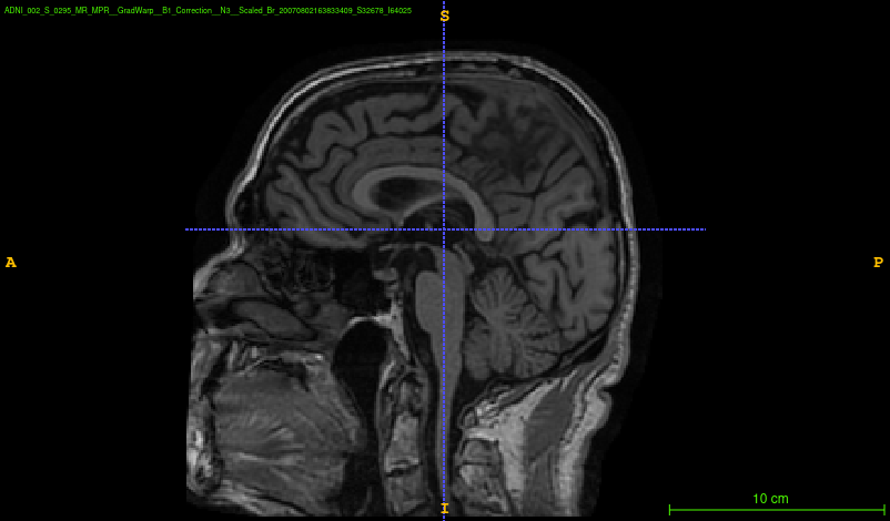 s32678_raw_sagittal.png