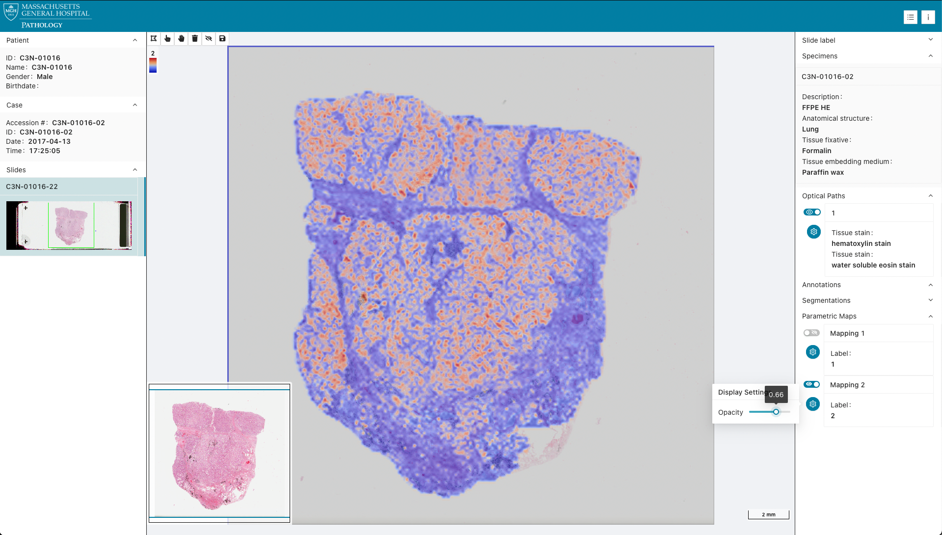 IDC_CPTAC_C3N-01016-22_parametric_map.png