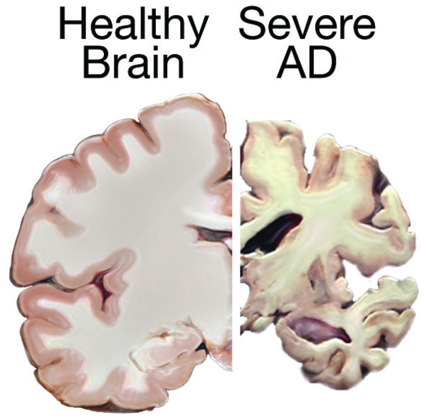 alzheimer-disease-brain.jpeg