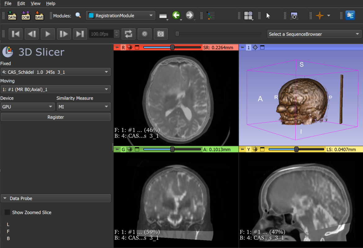RegistrationModule powered by ImFusion Libraries in 3D Slicer
