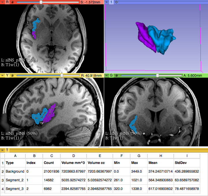 Parcellation of anterior an posterior Insula and volumetric measures