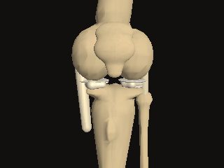 A right knee shows natural ivory cartilage, menisci and collateral ligaments