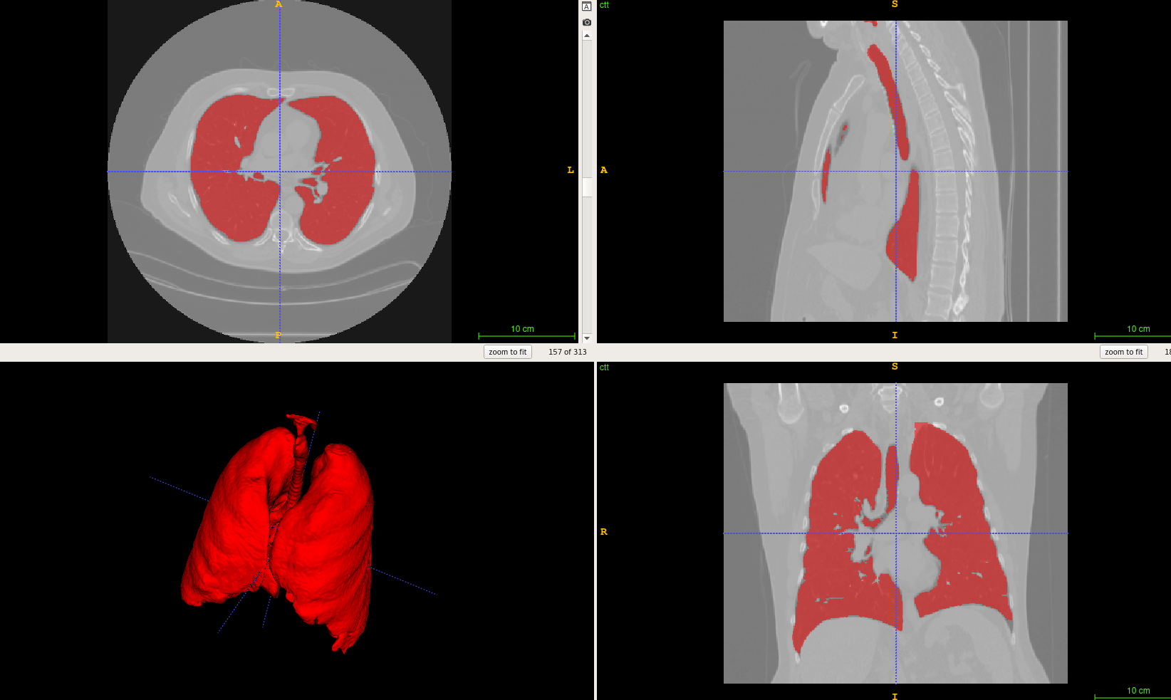 lung segmentation example