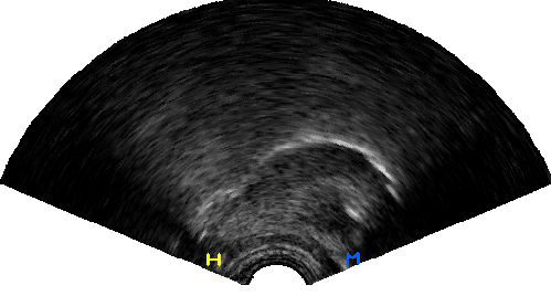 Image showing hyoid and mandible tracking markers on an ultrasound image