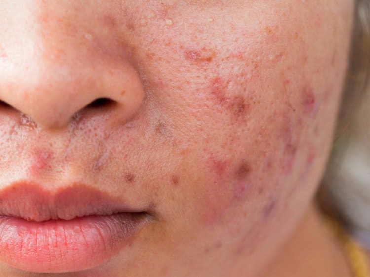 Does Milk Trigger Acne? Post