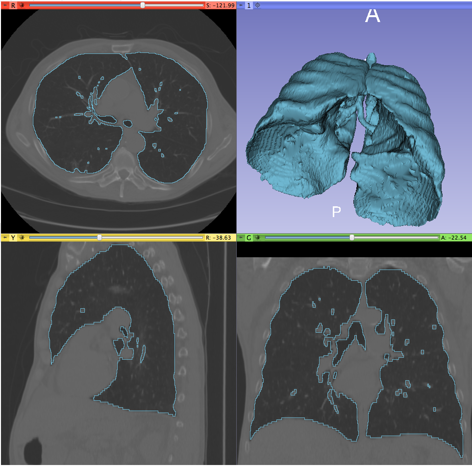 CTChest_seg_result.png