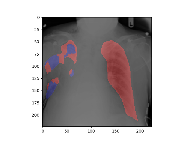 segmentation_opacification_failure.png