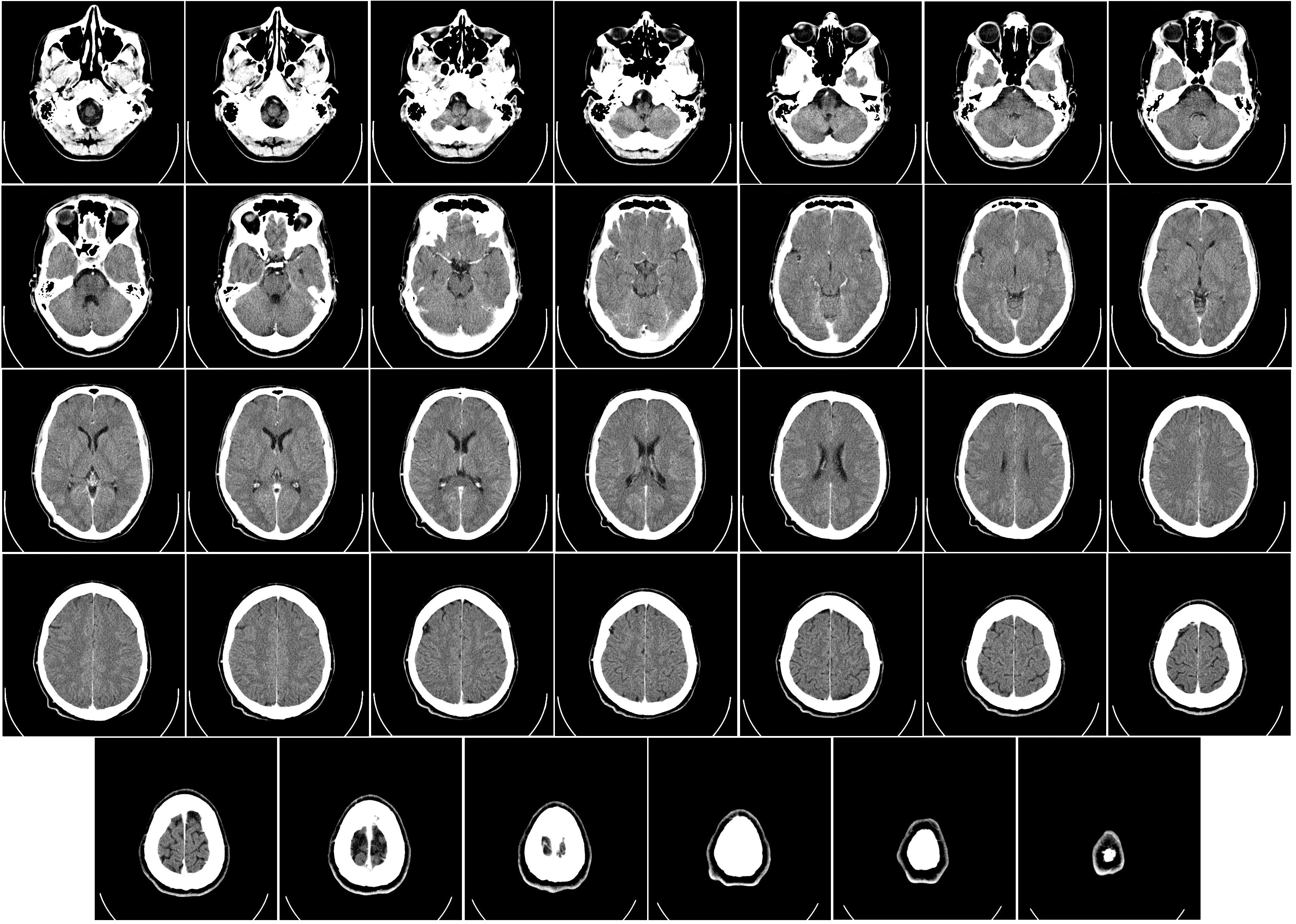 Computed_tomography_of_human_brain.png