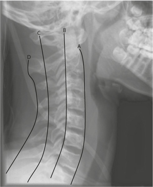 A: Anterior vertebral line; B: Anterior spinal line; C: Posterior spinal line; D: Spinous process