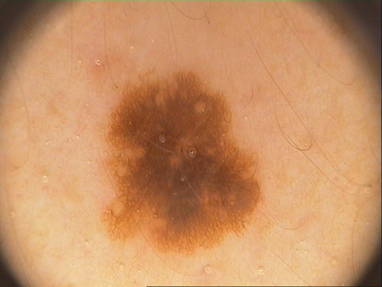 Non-Melanoma.jpg