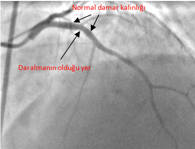 CT kalp resmi