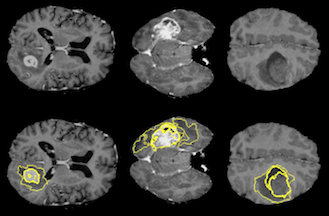 tumor_diversity.png