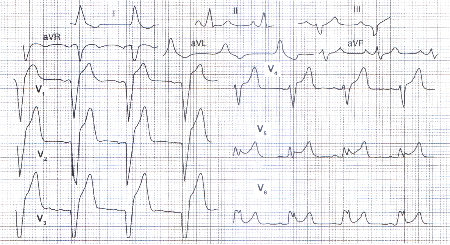 ecg-lbbb.png